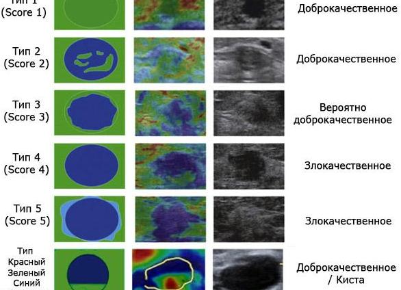 Эластография щитовидной железы что это такое