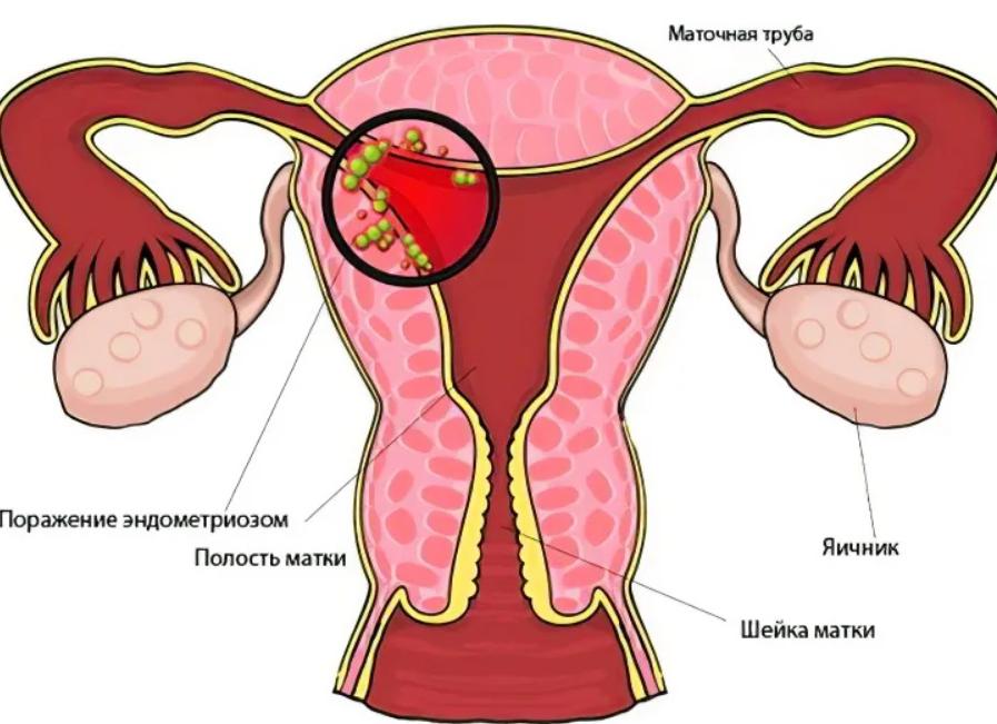 Что такое эндометрий в гинекологии у женщин Что такое эндометрий в гинекологии у женщин