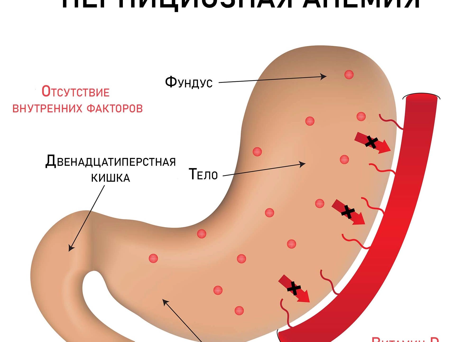 Б12 дефицитная анемия
