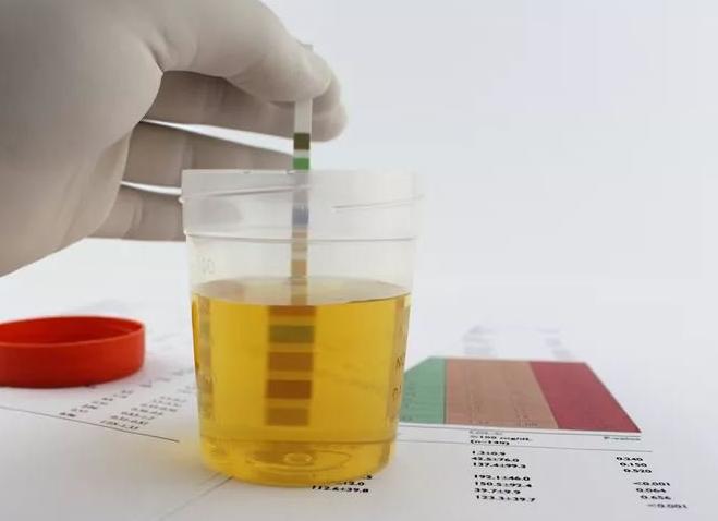 Анализ мочи на суточную протеинурию Анализ мочи на суточную протеинурию