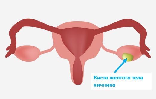 Киста желтого тела яичника что это