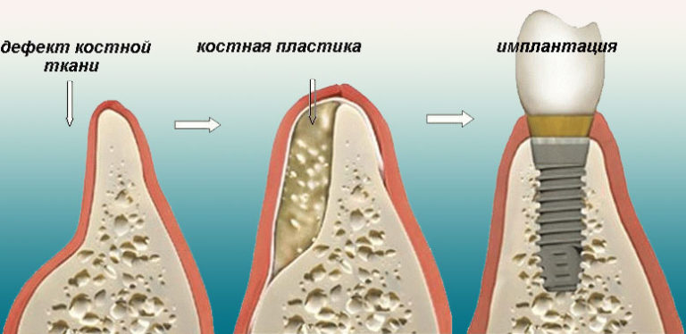 Костная ткань что такое