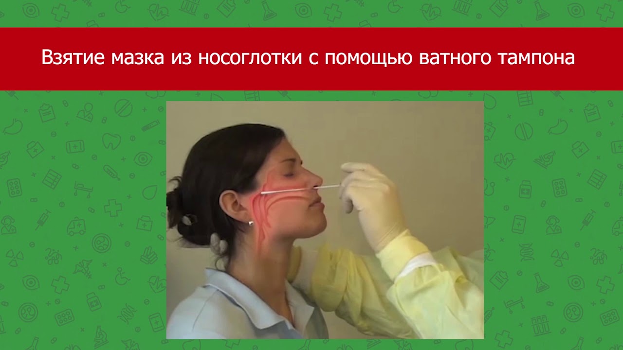 Мазок из носоглотки