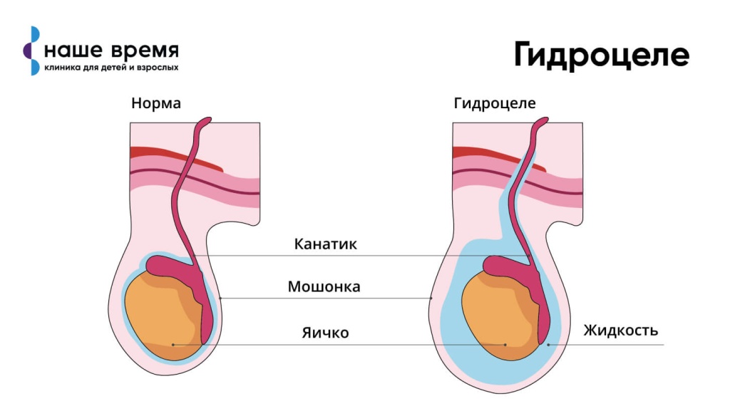 Мкб водянка яичка