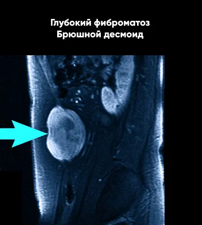 Мрт мягких тканей живота что показывает