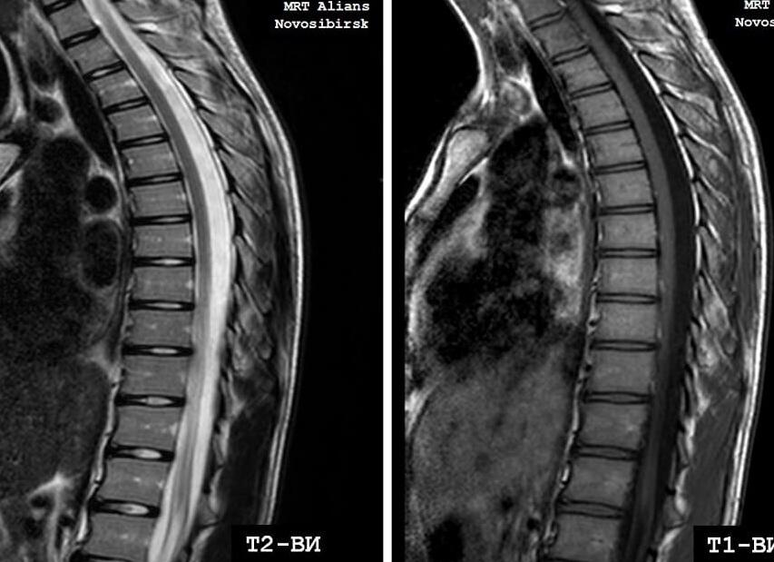 Мрт позвоночника грудного