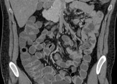 Мрт кишечника с контрастным веществом