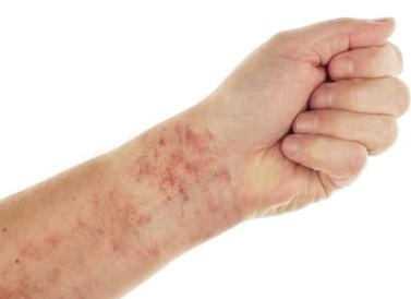 Лейкоз признаки заболевания у взрослых Лейкоз признаки заболевания у взрослых