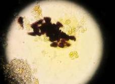 Крахмал в анализе кала у ребенка