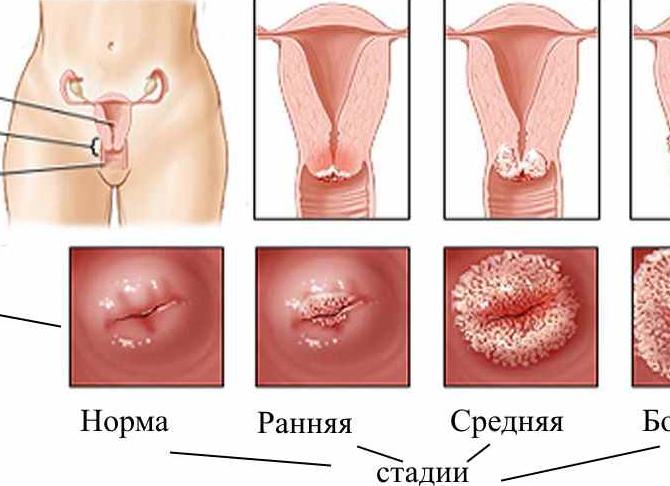 Кольпоскопия шейки матки эрозия