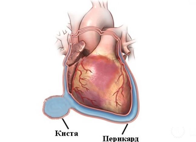 Киста в грудине как лечить