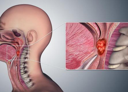 Как обследовать гортань Как обследовать гортань
