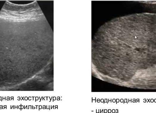 Эхоструктура печени неоднородная