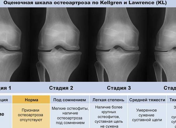 Деформирующий остеоартроз коленных суставов