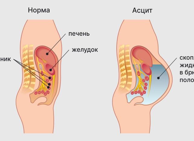 Цирроз печени как диагностировать