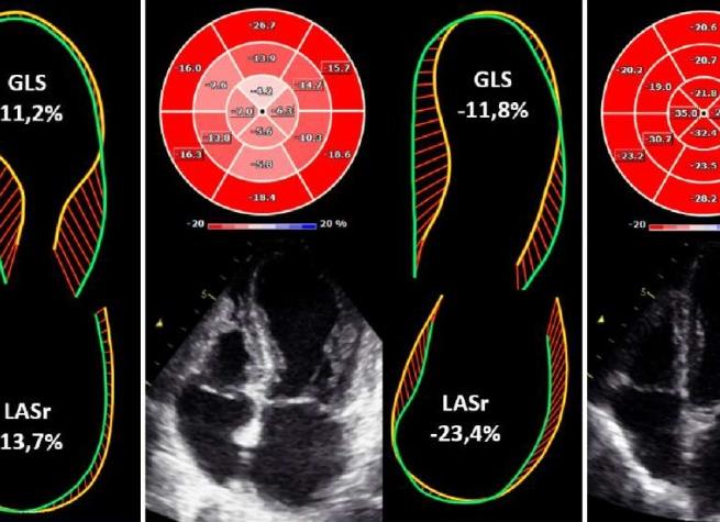 Асинергия мжп сердца что это