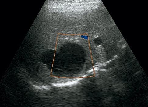 Анэхогенное образование в печени