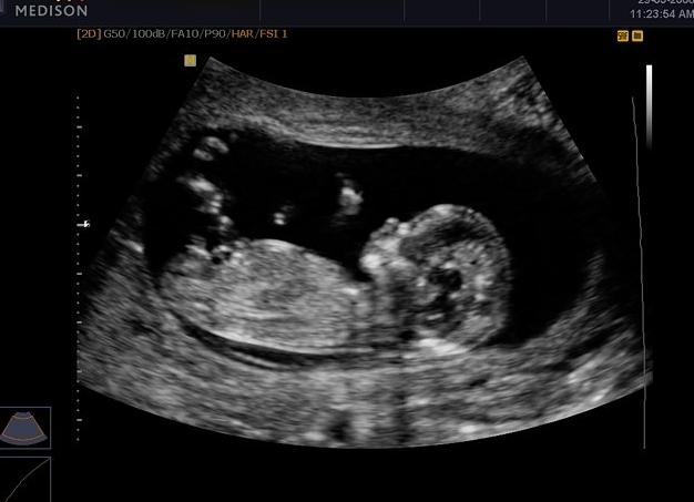 12 недель фото плода