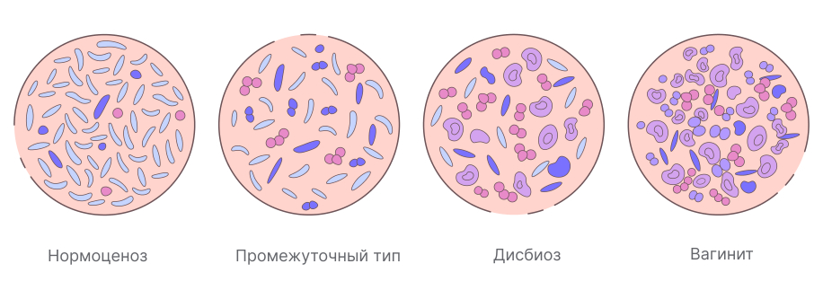 Анаэробный дисбиоз у женщин что это