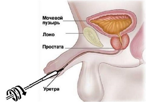 Анализ из уретры у мужчин