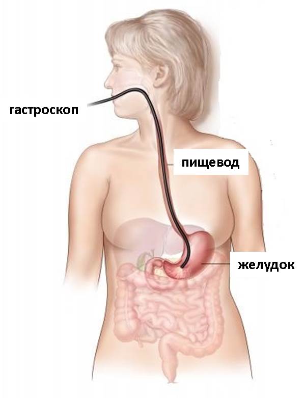 Как проводится гастроскопия желудка