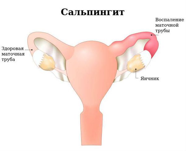 Киста правого яичника желтого тела