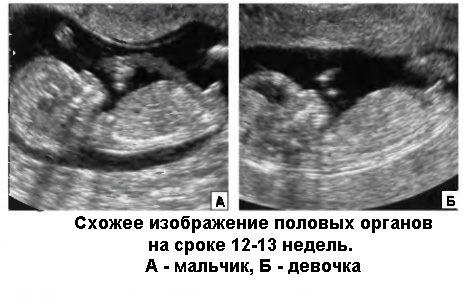 Когда пол ребенка можно увидеть