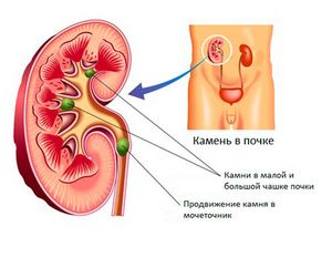 Кровь в моче что означает