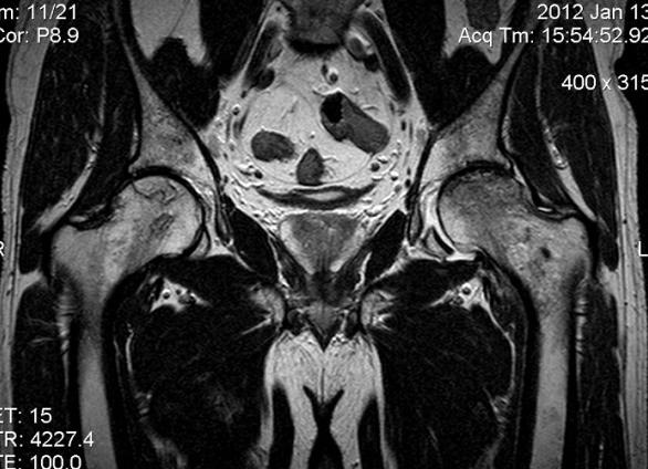 Мрт тазобедренного сустава что показывает