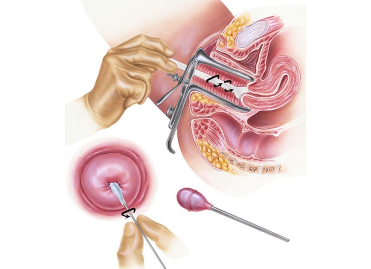 Мазок на раковые клетки гинекология