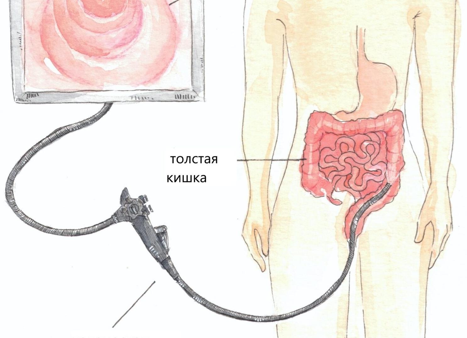 Колоноскопия подготовка к обследованию