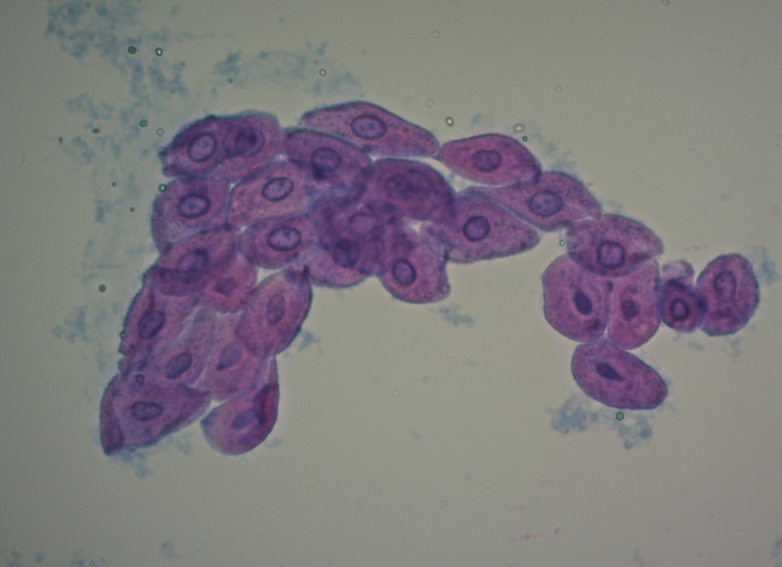 Клетки почечного эпителия в моче у ребенка