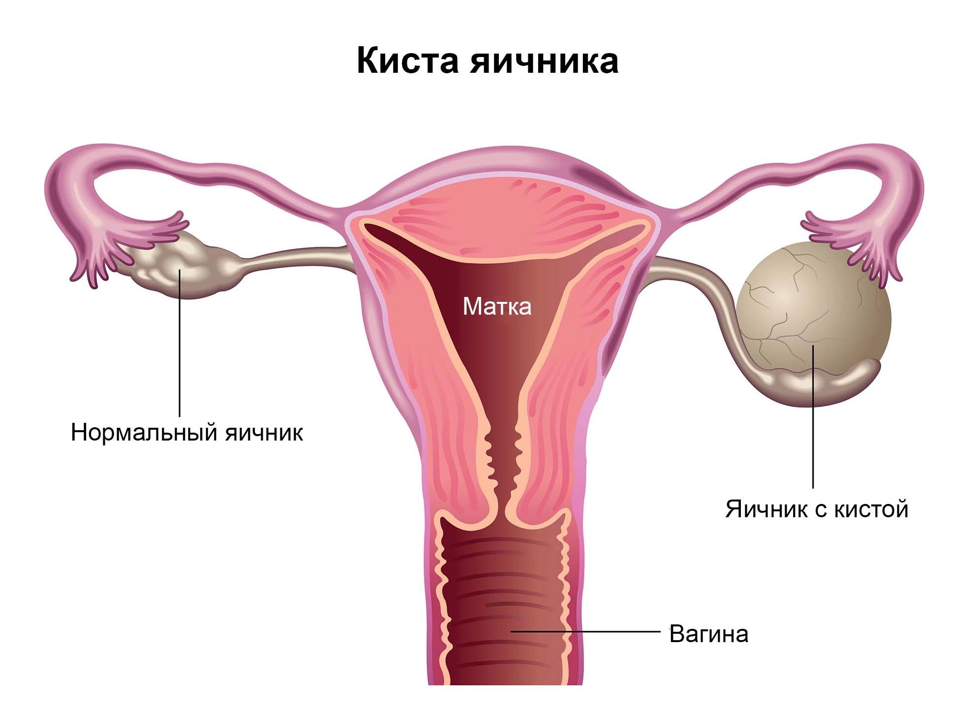 Киста на яичнике у женщины