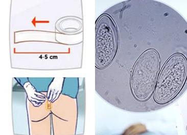 Как сдавать кал на анализ яйцеглист