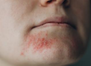 Как проявляется на коже стафилококк