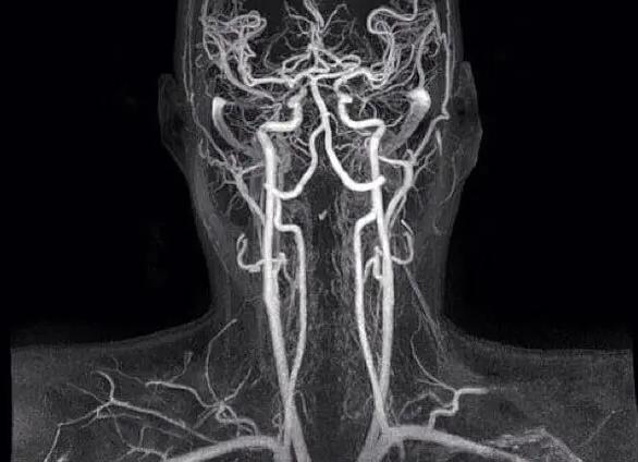 Как лечить спазмы сосудов головного мозга