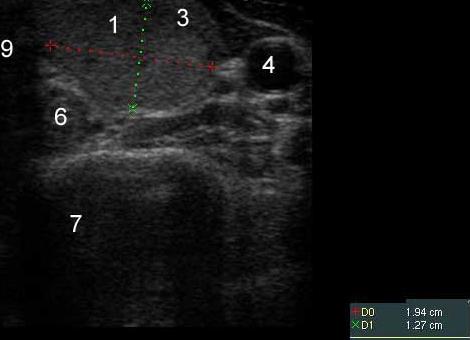 Изоэхогенный узел щитовидной железы с хало