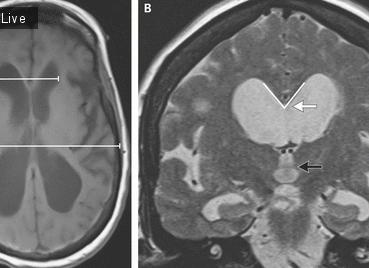 Индекс эванса что это
