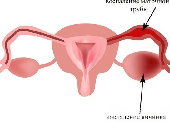 Хронический правосторонний аднексит