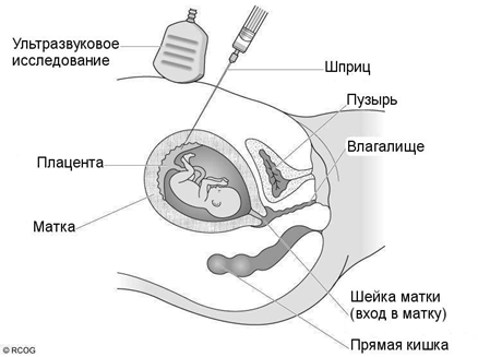 Как проводят скрининг 1 триместра