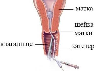 На какой день делают гсг маточных труб
