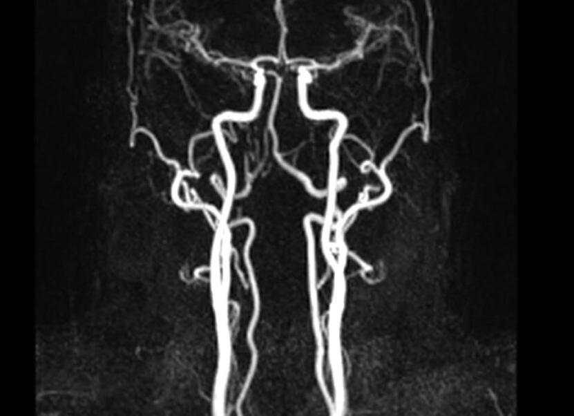 Мрт головного мозга в ангиорежиме что это