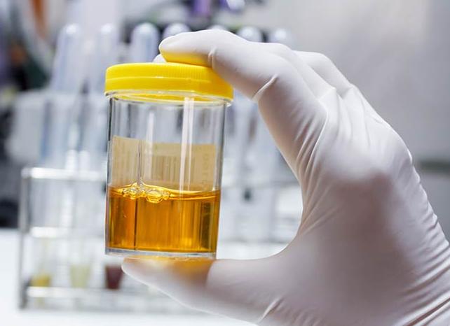 Много слизи в моче что это значит у мужчин