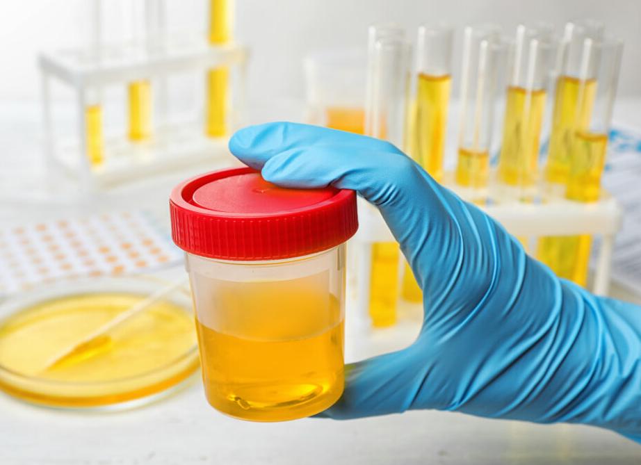 Лабораторные исследования мочи