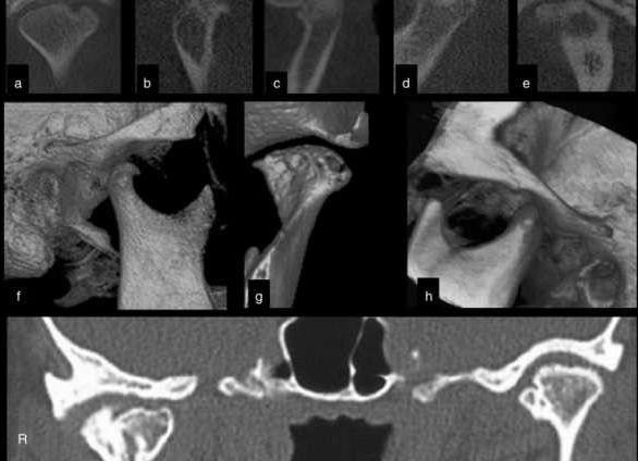 Кт височно нижнечелюстного сустава Кт височно нижнечелюстного сустава
