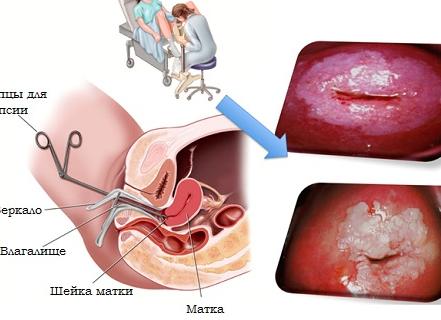 Кольпоскопия и биопсия шейки матки что это такое