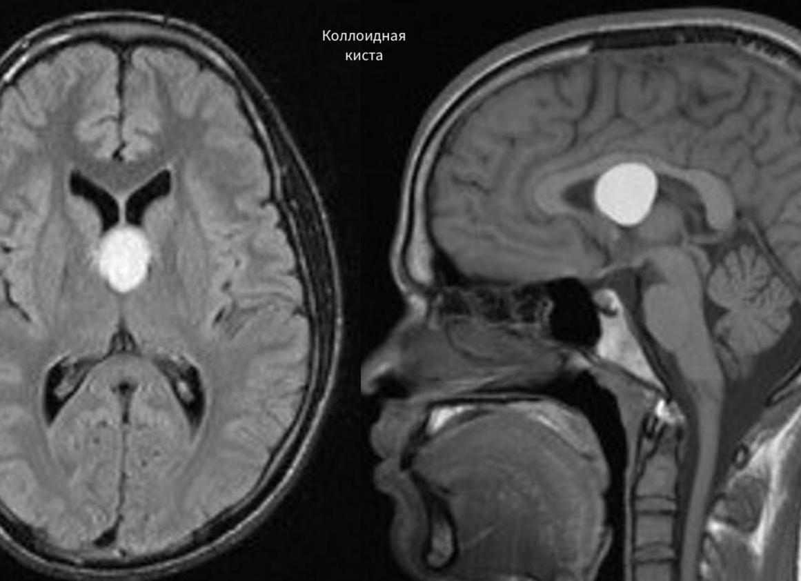 Киста мозга что это такое Киста мозга что это такое