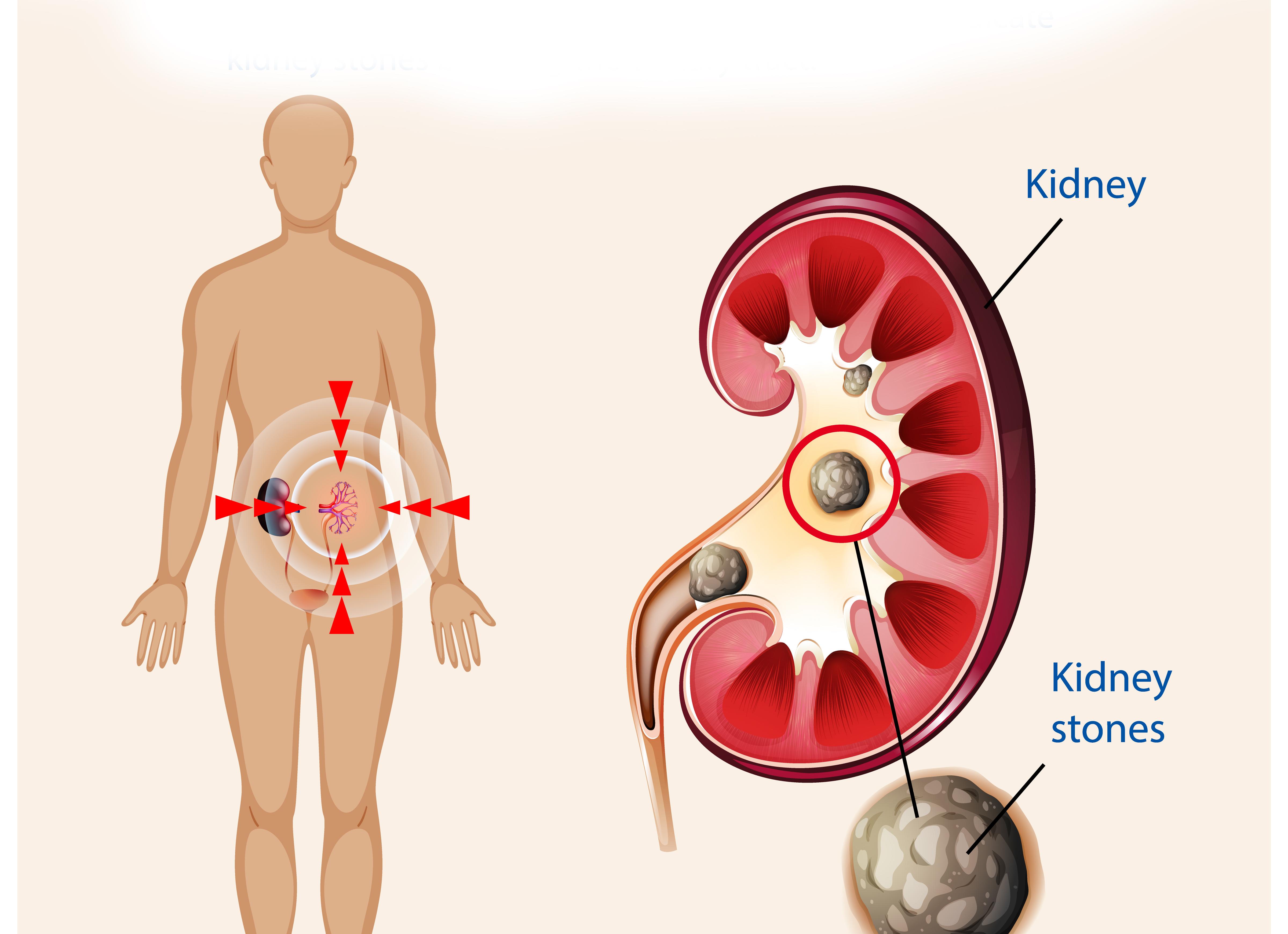 Кальций в моче повышен причины Кальций в моче повышен причины