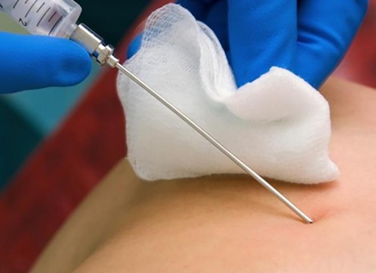 Как подготовиться к пункции щитовидной железы Как подготовиться к пункции щитовидной железы