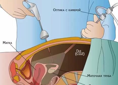 Как кисту удаляют